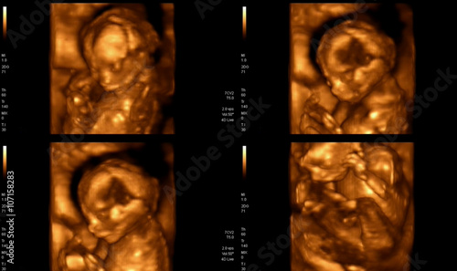 Medical images collage of 4D ultrasound during woman pregnancy s photo