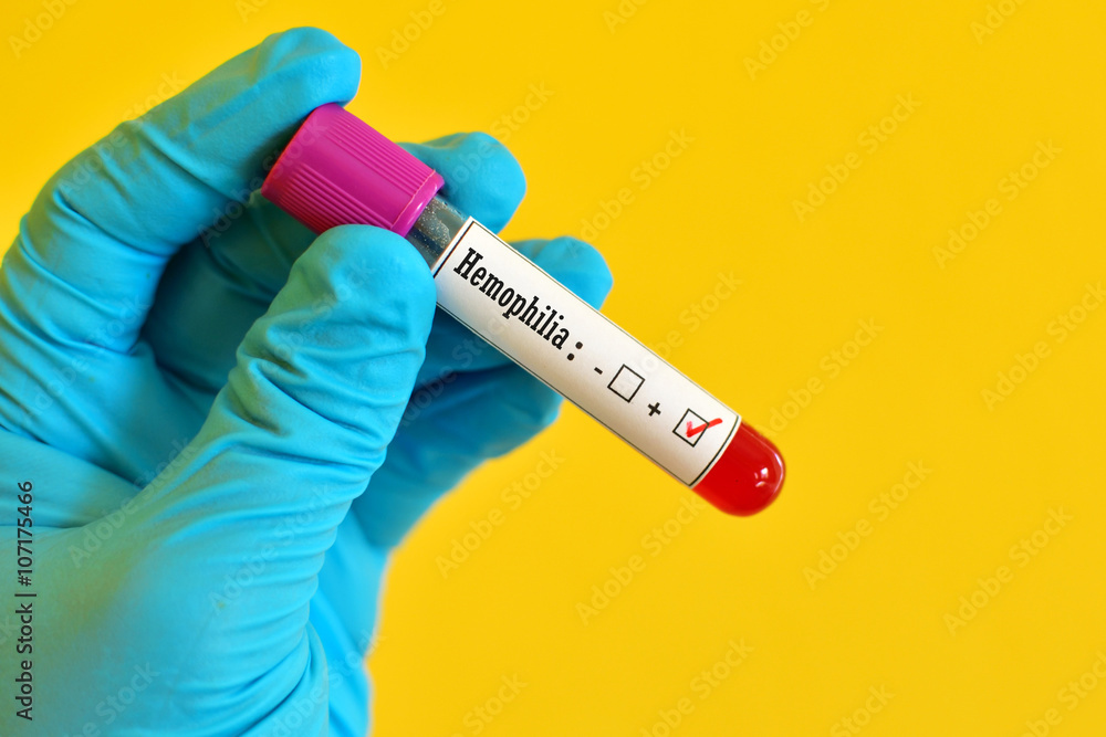 Obraz premium Blood sample positive with hemophilia