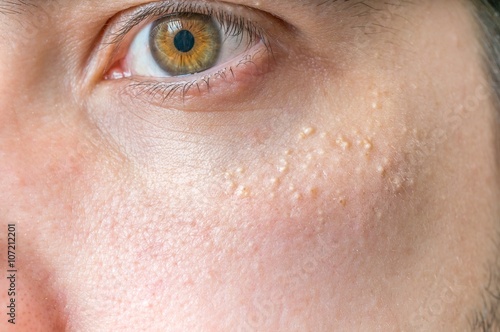 Milia (Milium) - pimples around eye on skin. photo