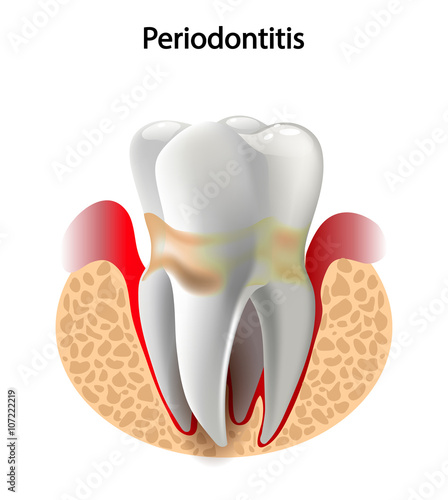 vector image tooth  Periodontitis disease