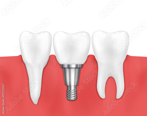 Dental implant and normal tooth vector illustration