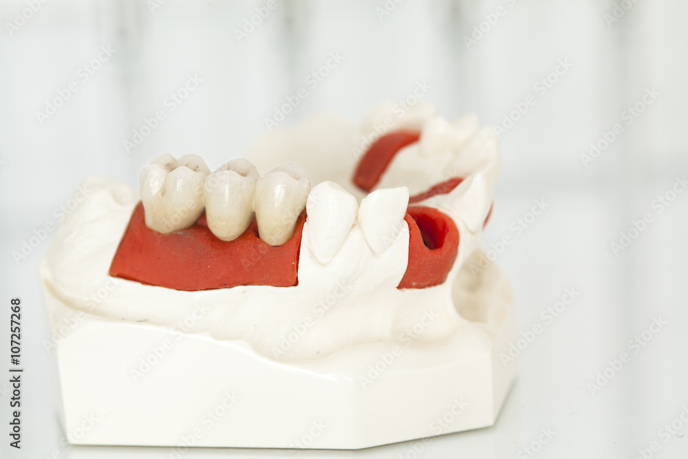 Metal free ceramic dental crowns Metal free ceramic dental crowns