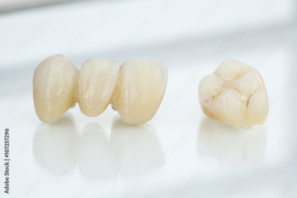 Metal free ceramic dental crowns Metal free ceramic dental crowns