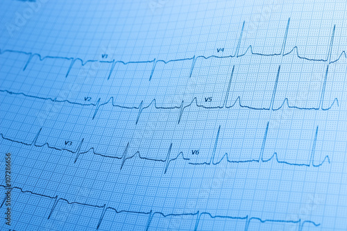 Electrocardiogram / ECG printed on graph paper.

A healthy ECG printed on white graph paper used for diagnosing heart disease.
