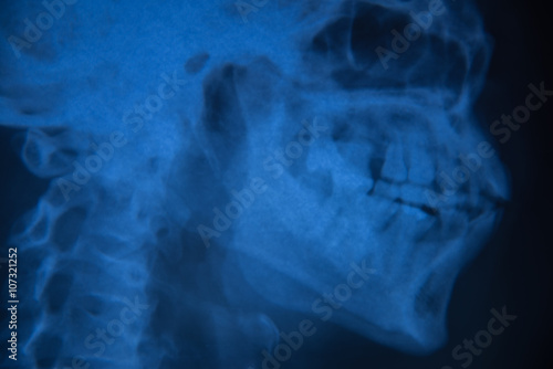 View of film x-ray skull of human