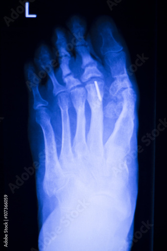 Foot toes metal implant xray scan