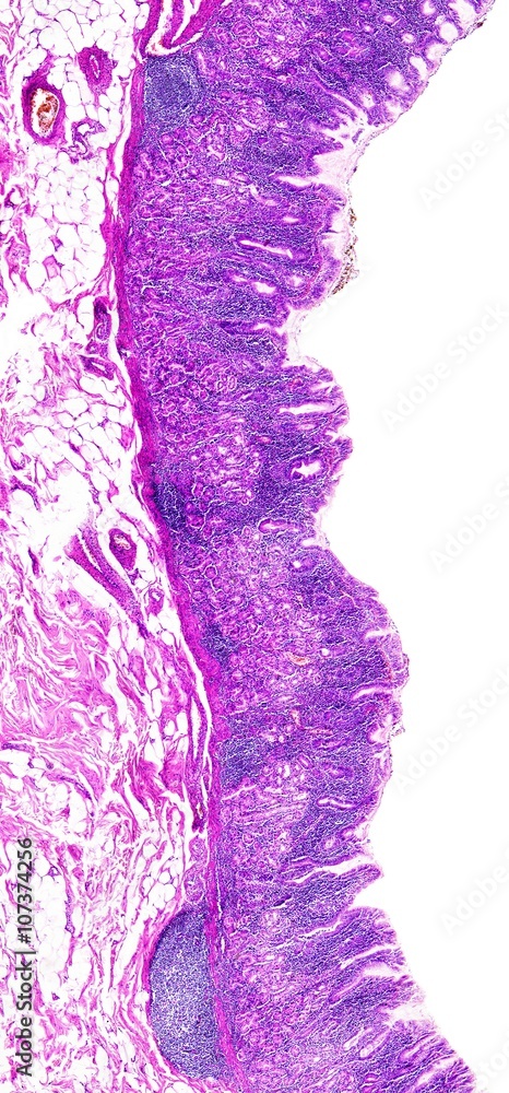 Obraz premium Chronic gastritis of a human
