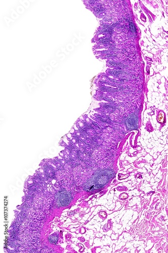 Chronic gastritis of a human