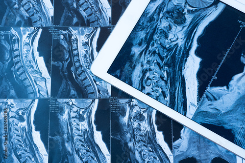 MRI Pictures of spinal column with magnification on overlaying t photo