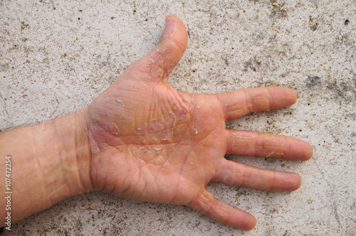 rissige Hand Neurodermitis mit gleichsam rissigem Hintergrund