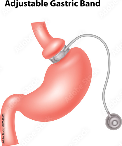 Illustration of Adjustable Gastric Band