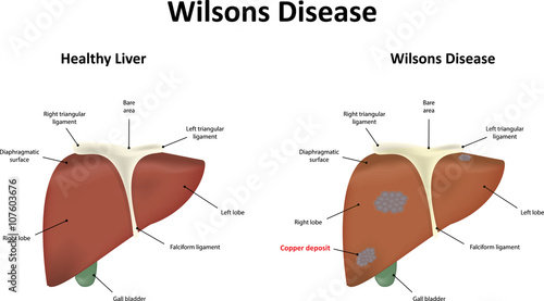 Wilsons Disease photo