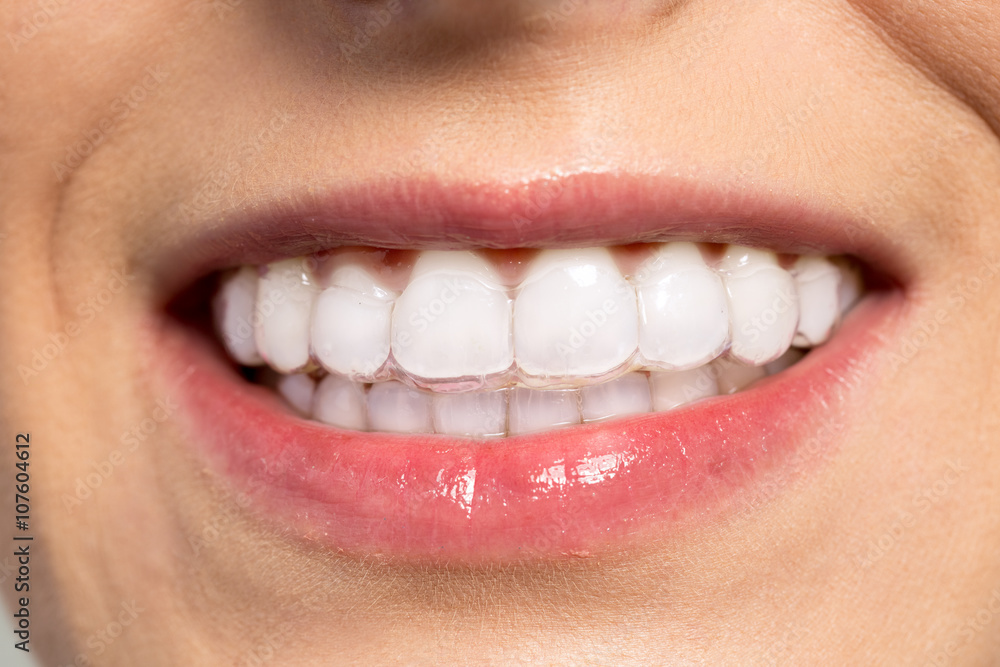 Fototapeta premium Woman wearing orthodontic silicone trainer