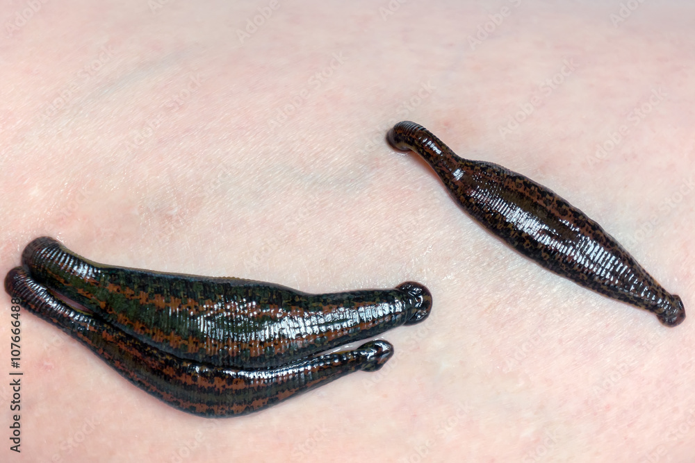 Leeches on human skin. Hirudotherapy varicose Stock Photo Adobe Stock