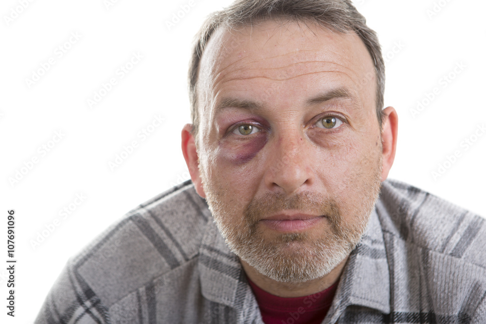 Middle-aged Caucasian male Emotional Portrait with a Real Bruise Middle-aged Caucasian male Emotional Portrait with a Real Bruise
