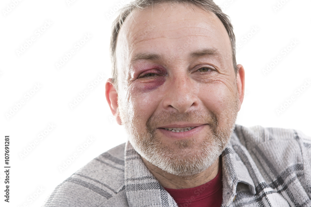 Obraz premium Middle-aged Caucasian male Emotional Portrait with a Real Bruise