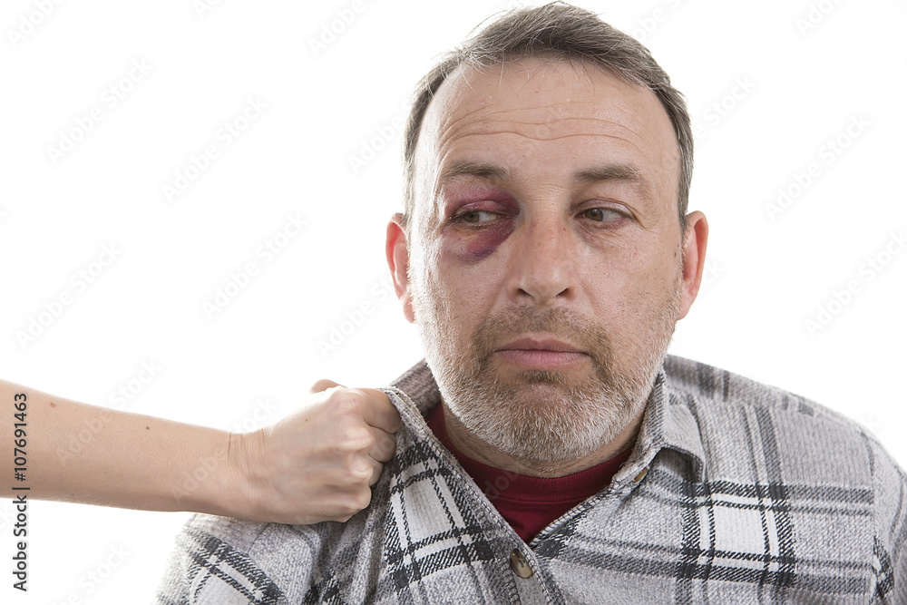 Middle-aged Caucasian male Emotional Portrait with a Real Bruise Middle-aged Caucasian male Emotional Portrait with a Real Bruise