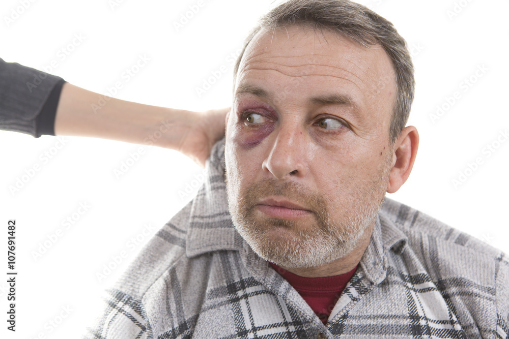 Middle-aged Caucasian male Emotional Portrait with a Real Bruise Middle-aged Caucasian male Emotional Portrait with a Real Bruise