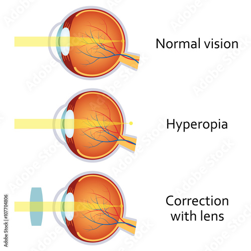 Hyperopia corrected by a plus lens