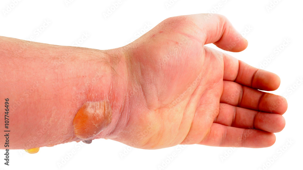 foto-stock-arm-with-blisters-caused-by-allergic-reaction-to-insect-bite