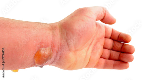 Fotografía Arm With Blisters Caused By Allergic Reaction To Insect Bite
