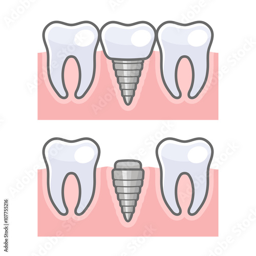 Dental Implant and Tooth Set. Vector