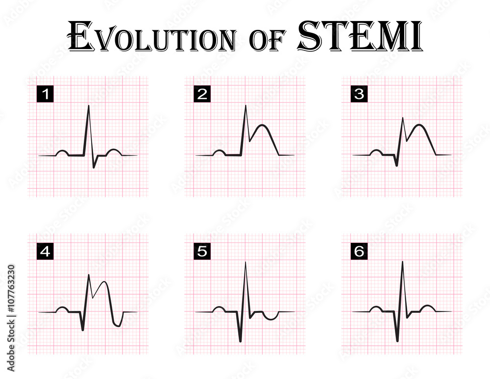 ECG of evolution ( step by step ) of STEMI ( ST elevation myocardial infarction ) Acute coronary syndrome , angina pectoris