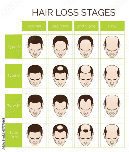Information chart of hair loss stages and types of baldness illustrated on a male head.