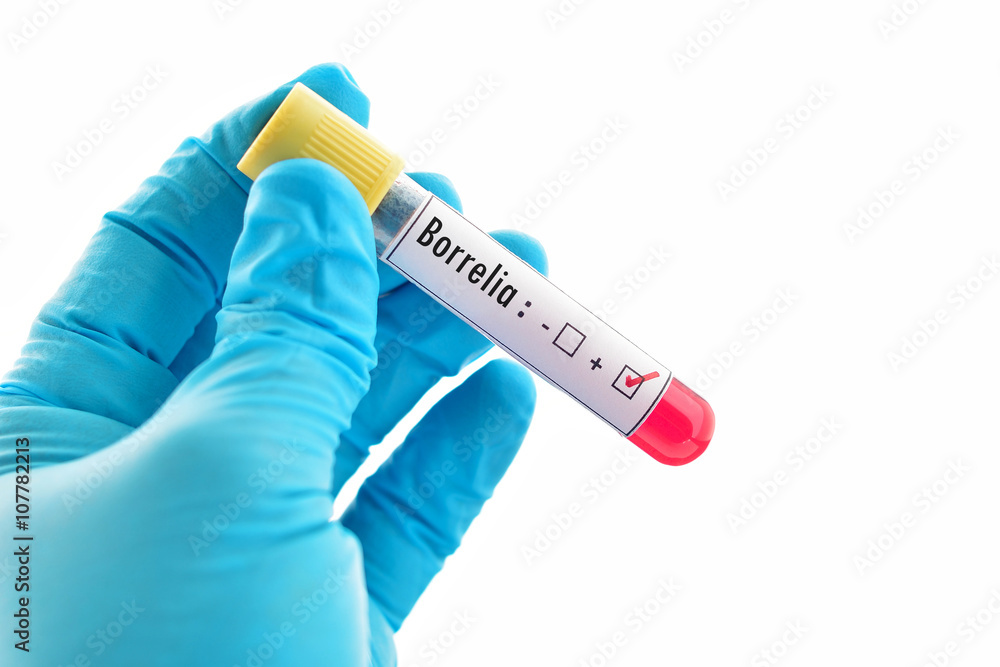 Obraz premium Blood sample positive with Borrelia test (Lyme disease diagnosis)
