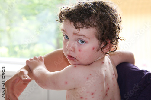 Obraz na plátně Sick child with chickenpox, sad girl looking back.