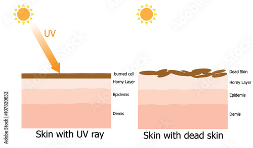 Cause of dead skin in human skin in summer