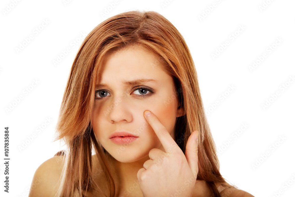 Teenage woman pointing on pimple on her cheek Teenage woman pointing on pimple on her cheek