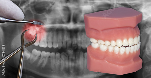 surgery extraction simulation, over dental scan