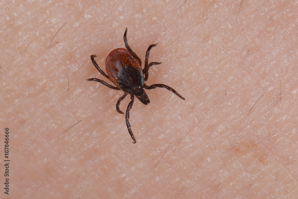 Holzbock Zecke (Ixodes ricinus) auf menschlicher Haut Holzbock Zecke (Ixodes ricinus) auf menschlicher Haut