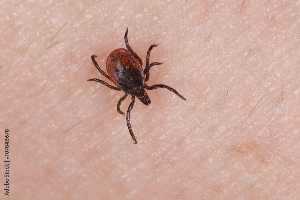 Holzbock Zecke (Ixodes ricinus) auf menschlicher Haut Holzbock Zecke (Ixodes ricinus) auf menschlicher Haut