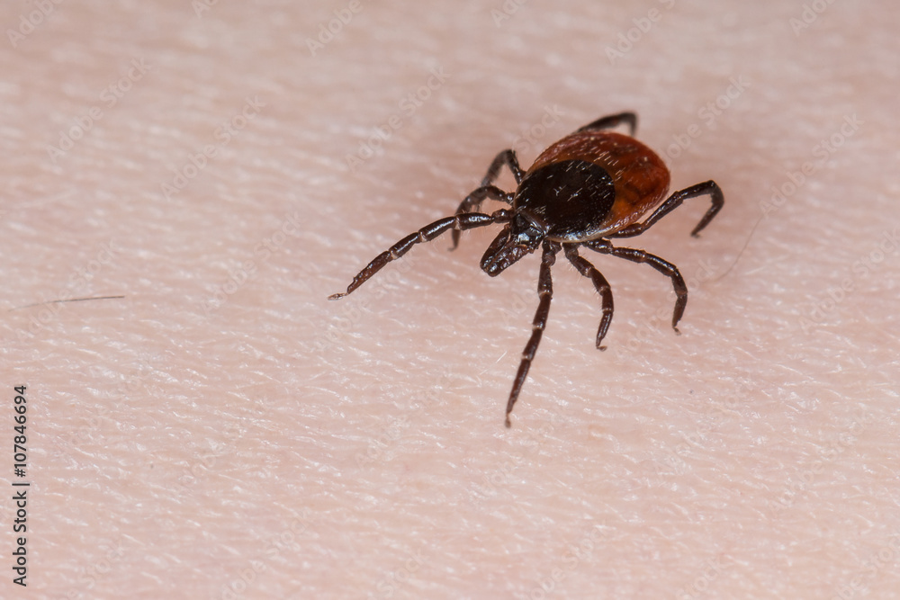 Holzbock Zecke (Ixodes ricinus) auf menschlicher Haut Holzbock Zecke (Ixodes ricinus) auf menschlicher Haut