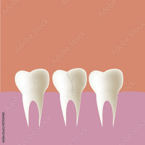broken tooth in mouth, Vector illustration.