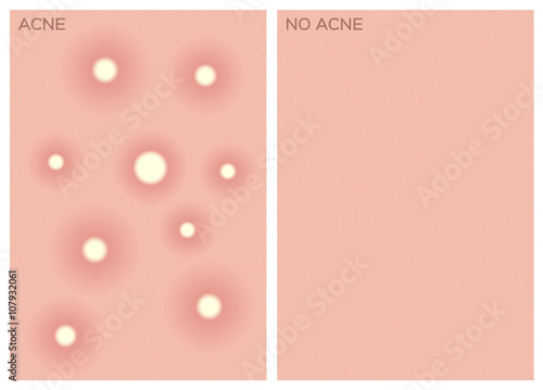 acne , before and after texture , vector