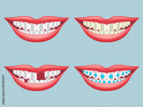 white, dirty, decayed, broken and orthodontics tooth vector