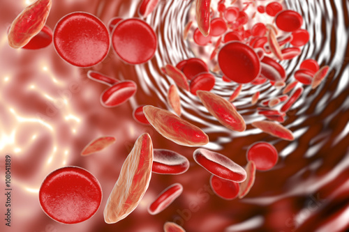 Sickle cell anemia, 3D illustration showing blood vessel with normal and deformated red blood cells photo