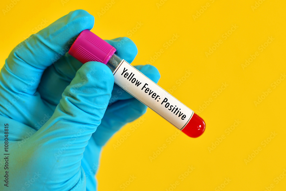 Obraz premium Blood sample positive with yellow fever test 
