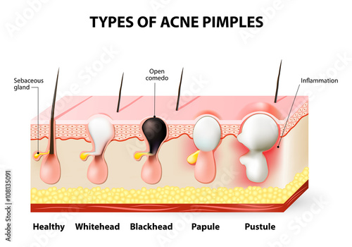 acne pimples