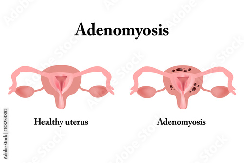 Endometriosis. The structure of the pelvic organs. Adenomyosis. The endometrium. Vector illustration