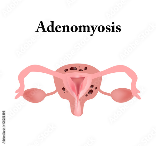 Endometriosis. The structure of the pelvic organs. Adenomyosis. The endometrium. Vector illustration 