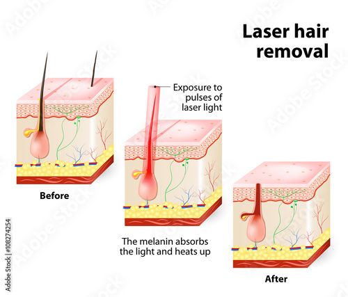 Laser hair removal. Vector diagram