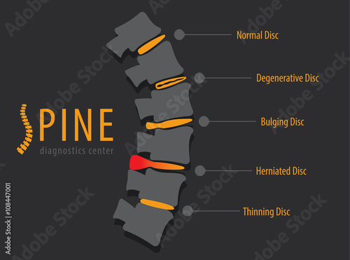 Spine anatomy disc degeneration, medical conceptual infographic vector