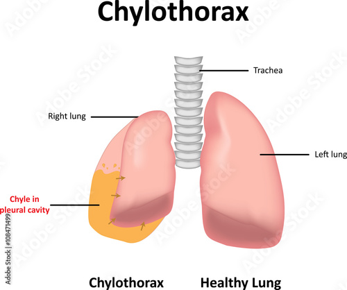 Chylothorax photo