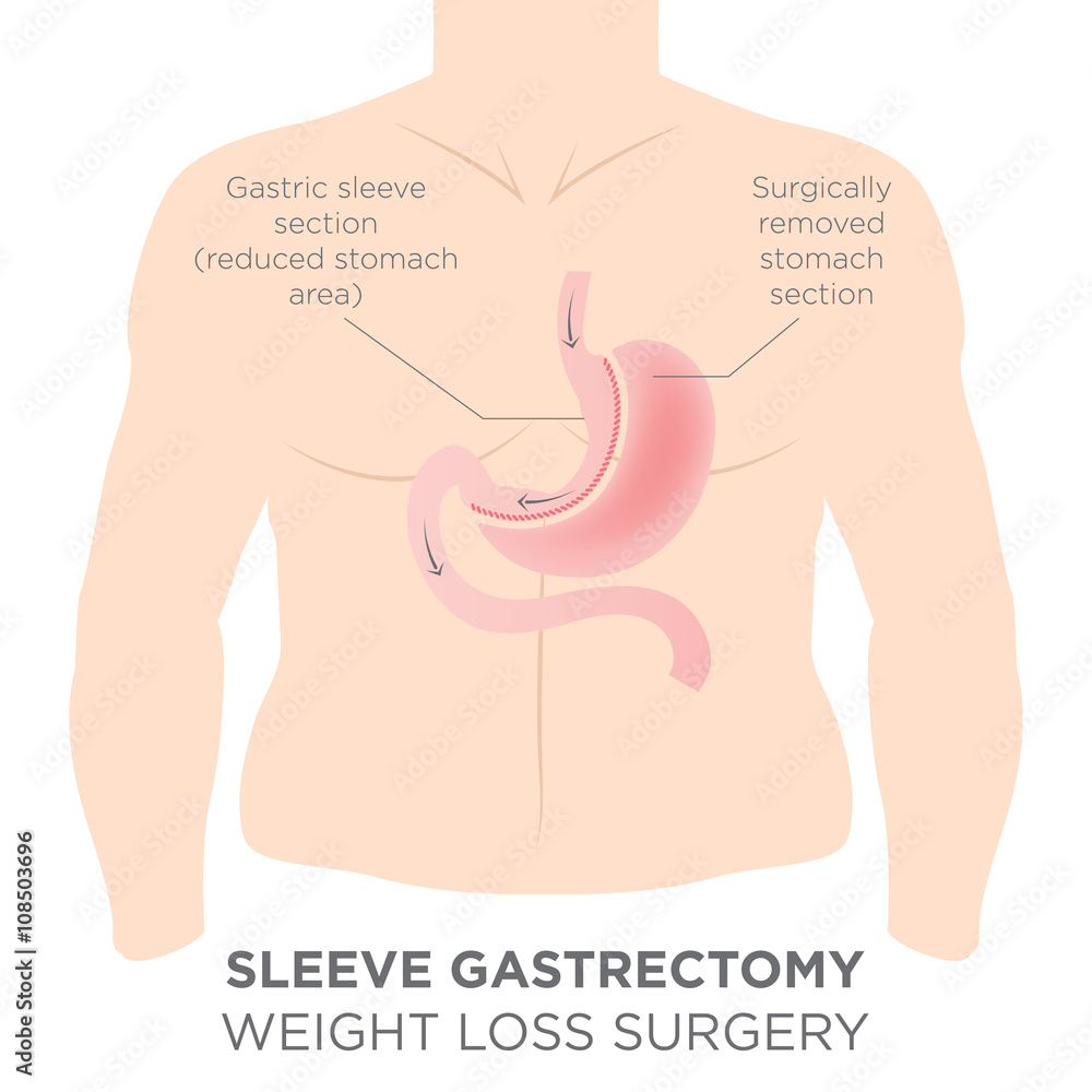 Stomach Staple Bariatric Surgery Resulting in 1/4 of the Stomach