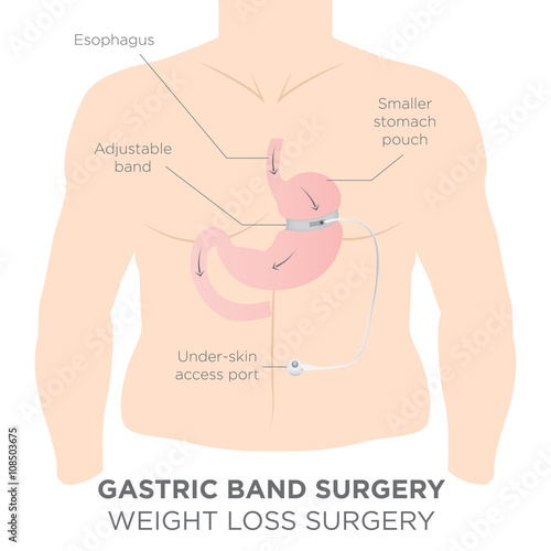 Gastric Band for Weight Loss.  If you Tighten or Loosen it, It Lets More Food in the Lower Stomach.  The Doctor Assistant Adjusts the Tightness of the Band with a Port that's Under the Skin.