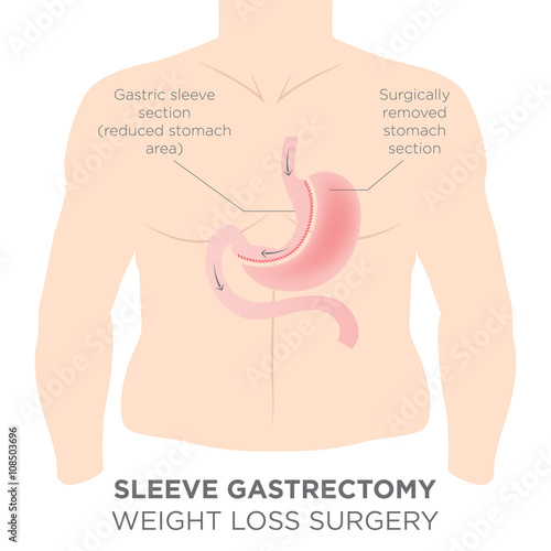 Stomach Staple Bariatric Surgery Resulting in 1/4 of the Stomach Removed.